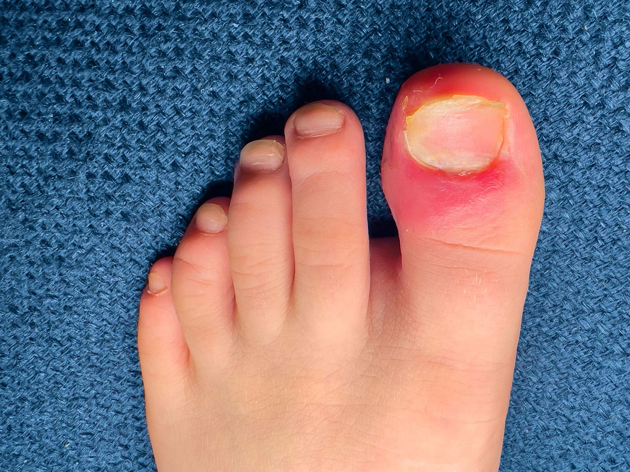  Ingrown Toe Nail